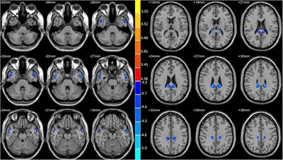 The decreased connectivity in middle temporal gyrus can be used as a potential neuroimaging biomarker for left temporal lobe epilepsy